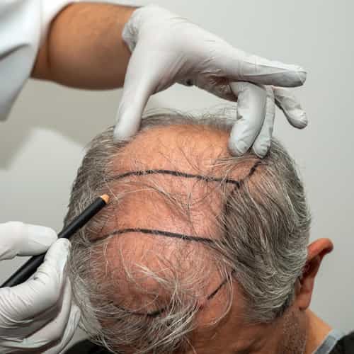 Hair Transplant in Turkey vs UK - Why More People Are Choosing Turkey